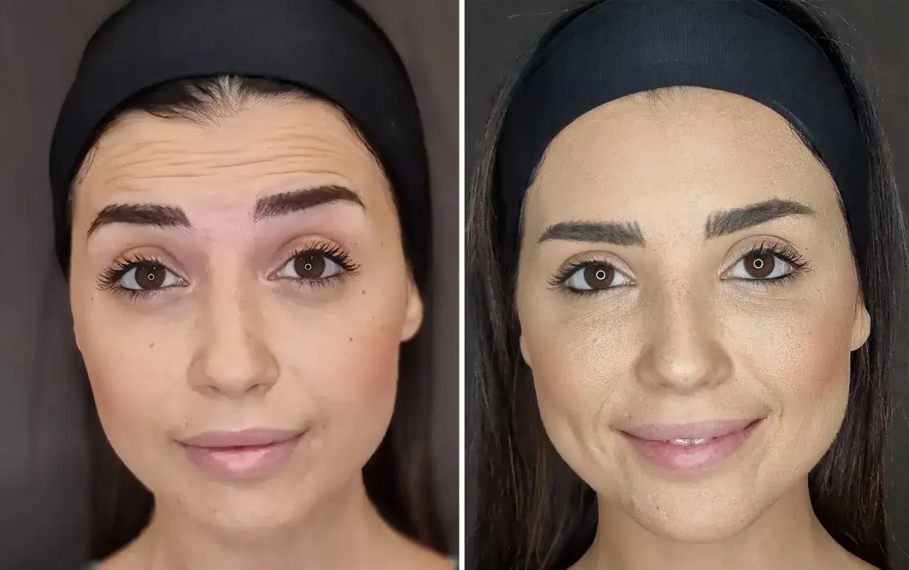 Confronto botox viso prima e dopo: fronte pi&ugrave; liscia e rughe d'espressione attenuate.